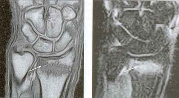 МРТ кисти: когда назначается?