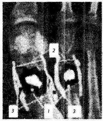 Локализация процесса при Spina ventosa tuberculosa