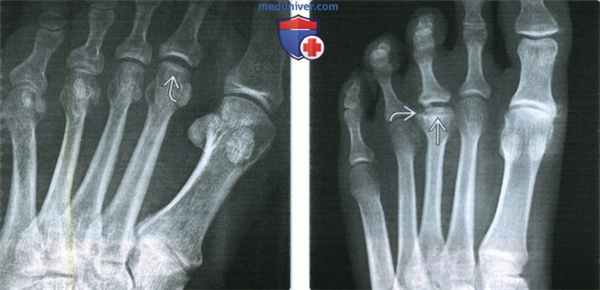 Признаки болезни Фрейберга