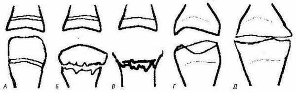 Динамика изменения при остеохондропатии головки плюсневой кости