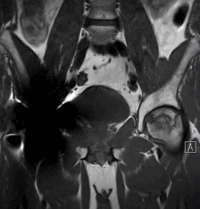 МРТ тазобедренных суставов 