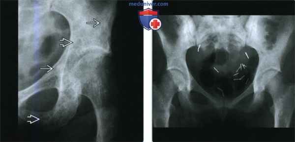 POEMS - лучевая диагностика