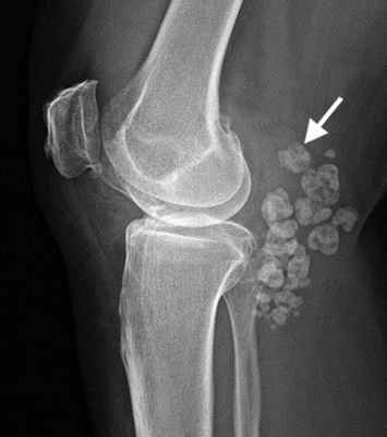 КТ Синовиальный хондроматоз