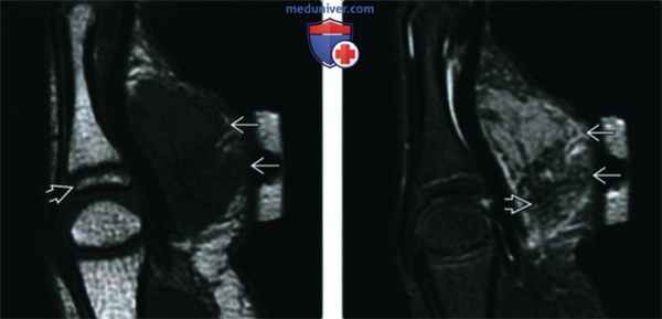 Кальцифицирующаяся апоневротическая фиброма - лучевая диагностика