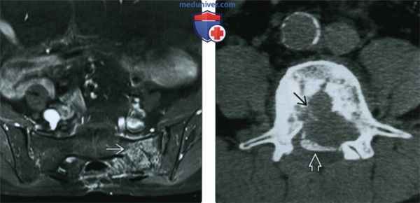 Рентгенограмма, МРТ при хордоме