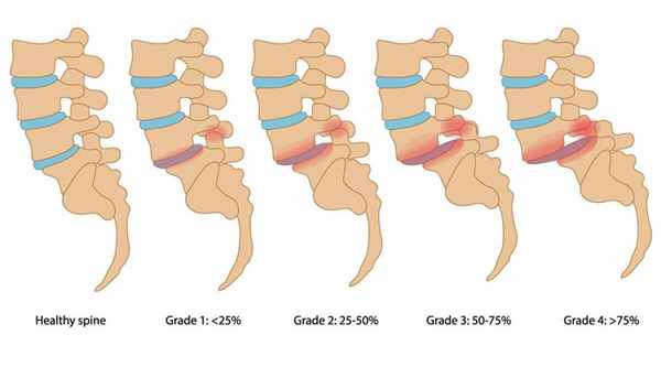 Спондилолистез позвоночника