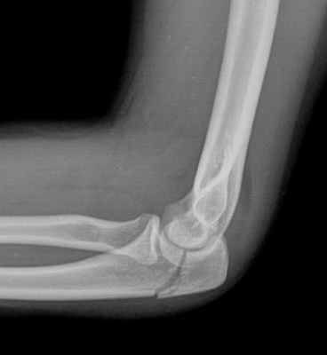 перелом локтевого отростка-обр.