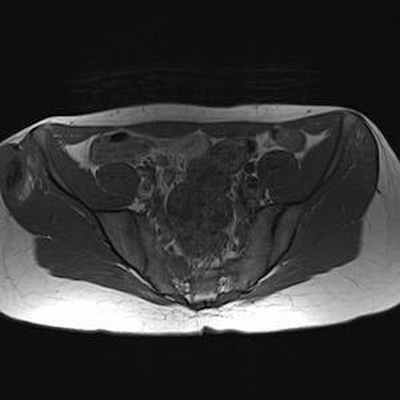 Хондросаркома на почве остеогенного экзостоза IRM Abdomen Axial Pondération T1