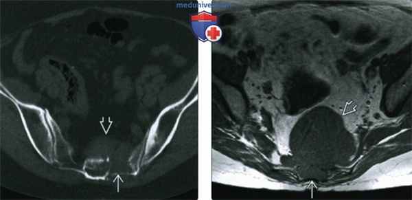 Рентгенограмма, МРТ при хордоме