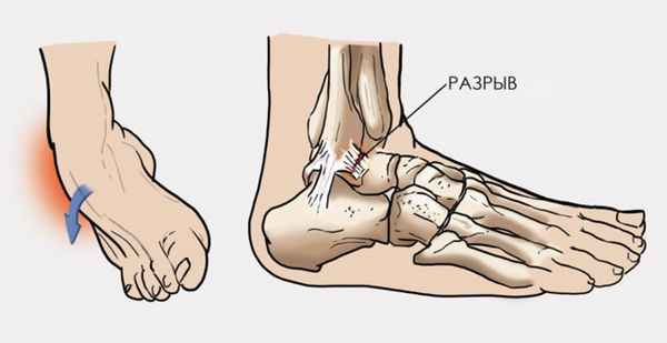 Межберцовый синдесмоз