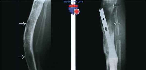 Фибросаркома - лучевая диагностика