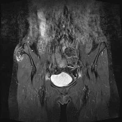 Хондросаркома на почве остеогенного экзостоза IRM Pelvis Coronal Pondération T1gado fat sat