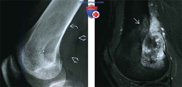 Фибросаркома - лучевая диагностика