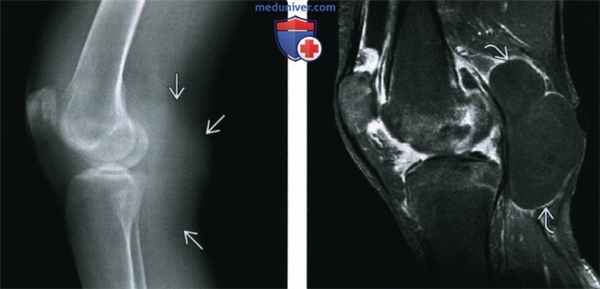 Рентгенограмма, МРТ при ревматоидном артрите коленного сустава