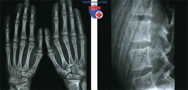 Синдромы Марфана и Элерса-Данлоса - лучевая диагностика