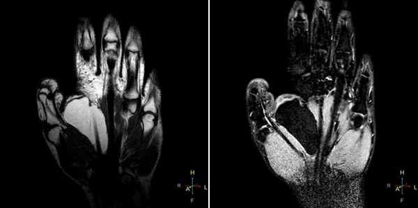 МРТ кисти: когда назначается?