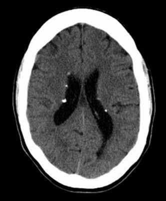 туберозный склероз