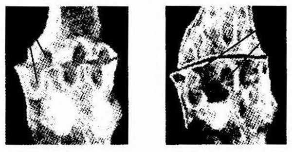 Рентгенологические признаки подагры