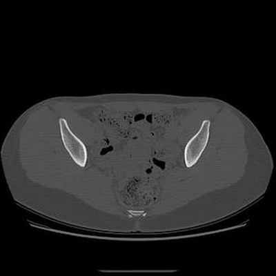 Хондросаркома на почве остеогенного экзостоза TDM Pelvis Axial