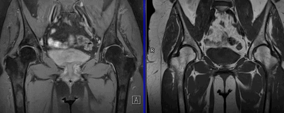 МРТ тазобедренных суставов