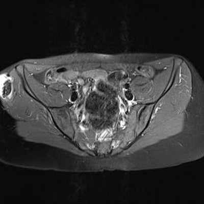 Хондросаркома на почве остеогенного экзостоза IRM Pelvis Axial Pondération DP