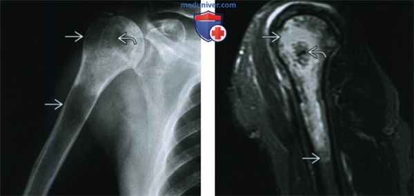 Светлоклеточная хондросаркома - лучевая диагностика