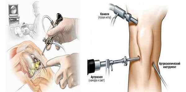 Артроскопия