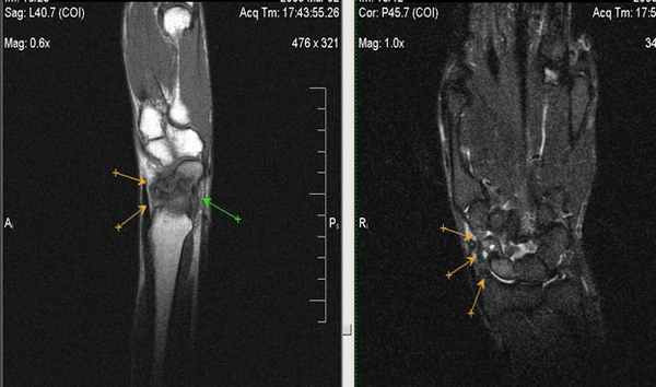 МРТ кисти: когда назначается?
