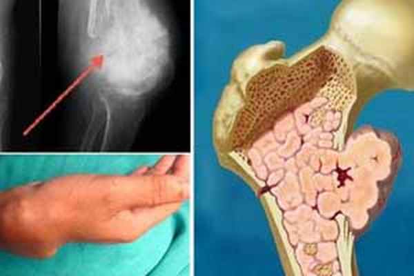 хондросаркома