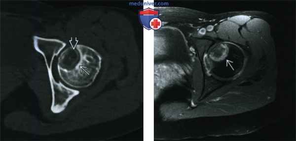 Светлоклеточная хондросаркома - лучевая диагностика
