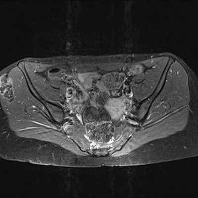 Хондросаркома на почве остеогенного экзостоза IRM Pelvis Axial Pondération T1gadolinium fat sat