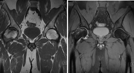 асептический некроз головки бедренной кости