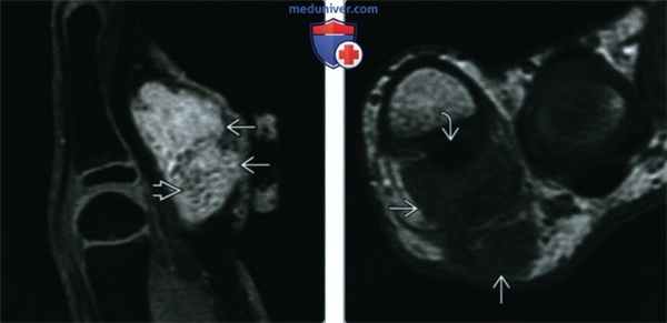 Кальцифицирующаяся апоневротическая фиброма - лучевая диагностика