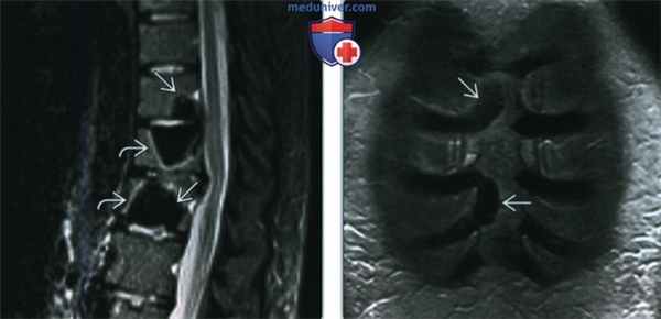 POEMS - лучевая диагностика