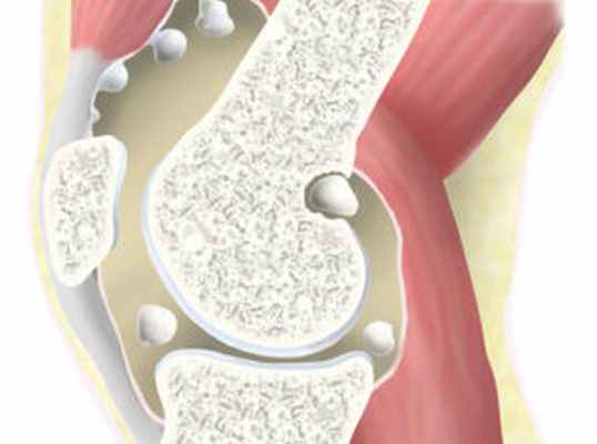 Синовиальный хондроматоз