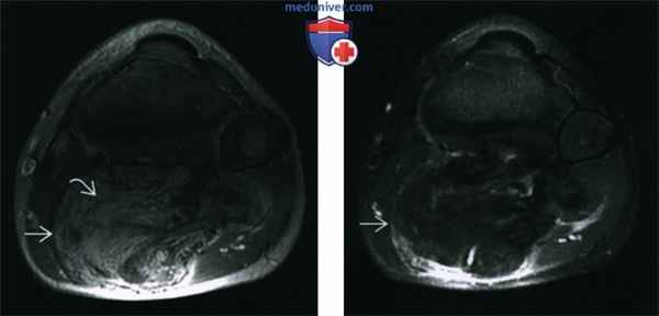 Липобластома и липобластоматоз мягких тканей - лучевая диагностика