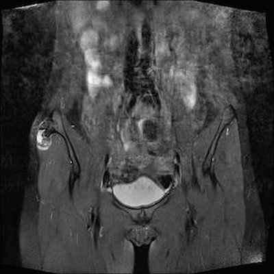 Хондросаркома на почве остеогенного экзостоза IRM Pelvis Coronal Pondération DP