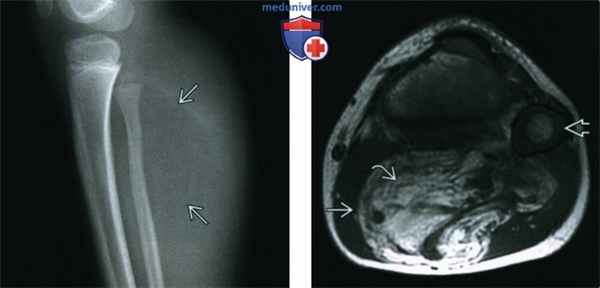 Липобластома и липобластоматоз мягких тканей - лучевая диагностика