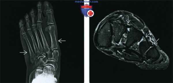 Синдромы Марфана и Элерса-Данлоса - лучевая диагностика