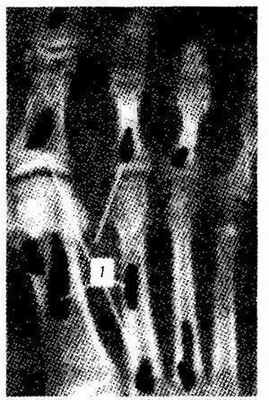 Локализация процесса при остите Морозова—Юнглинга