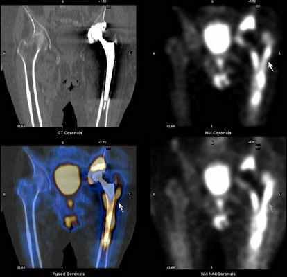 результат сцинтиграфии