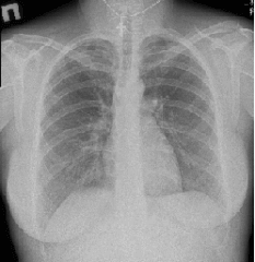 Рентген грудного отдела позвоночника