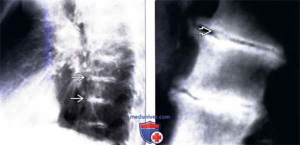 Рентгенограмма позвоночника при охронозе
