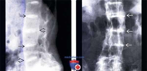 Рентгенограмма позвоночника при охронозе