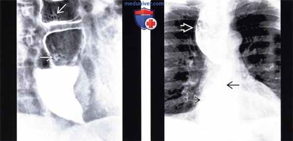 Рентгенограмма, КТ при ахалазии кардиального отдела пищевода