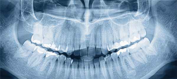 Рентген носовых пазух