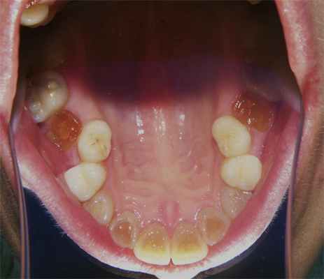 Рис. 3. Цвет обнаженного дентина.