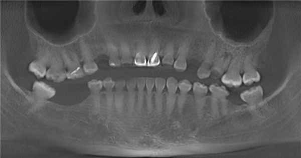 Рис. 4. ОПТГ младшей сестры.
