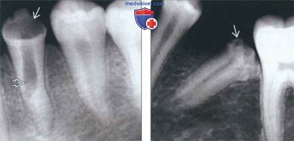 Рентгенограмма при дисплазии Тернера (зуба Тернера)