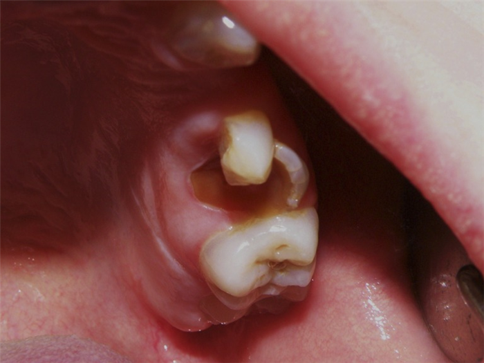 Рис. 2. Глубокие сколы зубов.